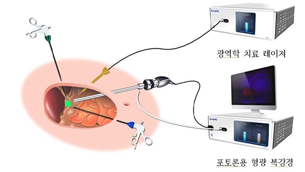 복강경 기반 형광 영상 가이드 광역학 진단 및 치료시스템 (제공: 동성제약)