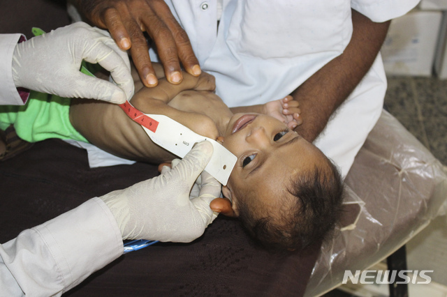 [데이르알하시=AP/뉴시스]지난 6월 14일(현지시간) 예멘 데이르 알 하시의 한 병원에서 생후 7개월 된 이사 이브라힘 나제르가 신체검사를 받고 있다. 이 아이의 체중은 불과 3kg으로 예멘에는 수백 명의 아이가 가난과 갈등으로 극심한 영양실조에 시달리고 있다.