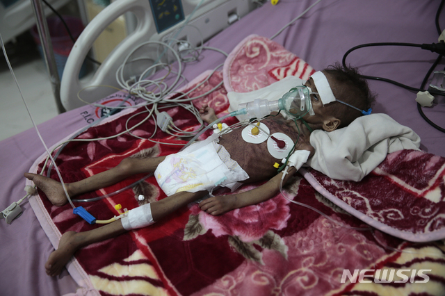 11월 3일 예멘 사나에 있는 알사빈 병원에서 영양실조를 겪고 있는 소녀 라흐마 와트히크가 치료를 받고 있다. 현지 구호단체에 따르면 약 2800만명의 예멘 인구 중 3분의 2가량이 굶주리고 있다. (출처: 뉴시스/AP)