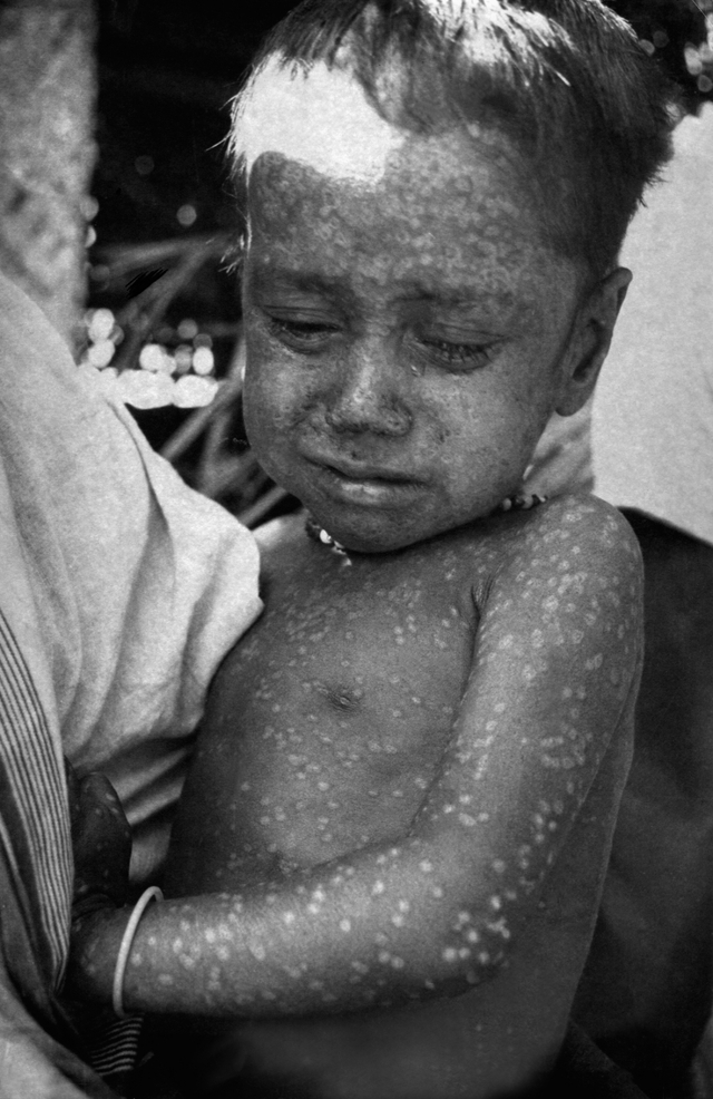 천연두에 감염된 소년의 모습. (출처: 위키백과)
