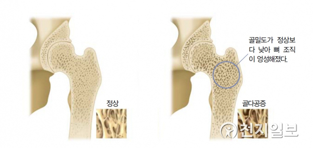 정상 뼈(왼쪽)와 골다공증이 있는 뼈(오른쪽) (제공: 자생한방병원) ⓒ천지일보 2021.5.6