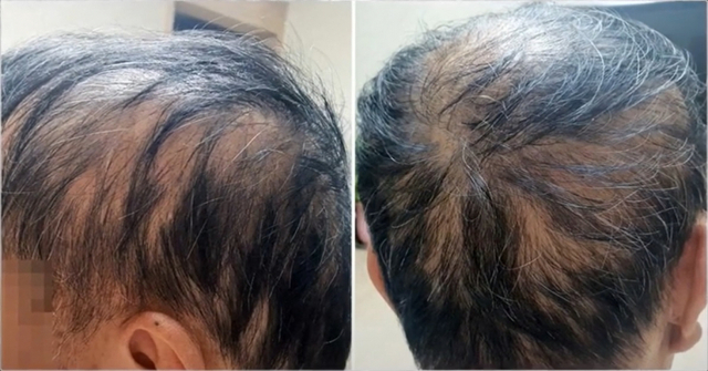 청원자가 올린 탈모된 남편의 머리 모습. (캡쳐: 유튜브). ⓒ천지일보 2021.10.8