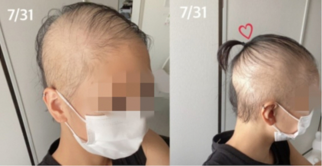 일본의 한 20대 여성이 모더나 백신을 맞고 탈모증에 걸렸다고 주장했다. 사진은 탈모된 머리 모습. (캡쳐: 블로그) ⓒ천지일보 2021.10.13