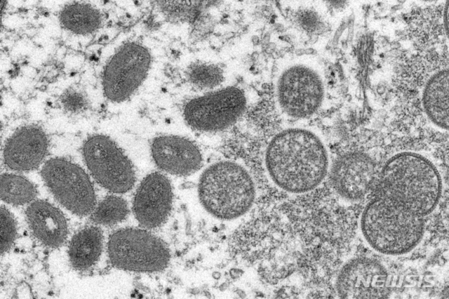 2003년 미국에서 프레리독으로부터 원숭이두창이 감염된 사람의 피부 샘플. 원숭이두창 바이러스가 보인다. (출처: 뉴시스, 미국 질병통제예방센터)