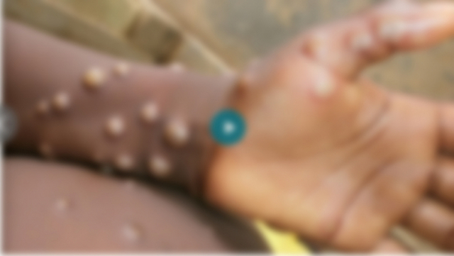 원숭이두창(monkeypox)에 감염된 환자의 손. (출처: WHO, 나이지리아 보건당국, 유로뉴스)