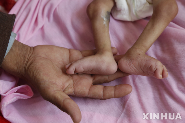 2020년 12월 13일 예멘 사나에 있는 알사빈 병원에서 아버지가 영양실조 아동의 발을 손에 들고 있는 모습. (출처: 뉴시스)